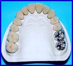 Full kim loại( chụp thép)